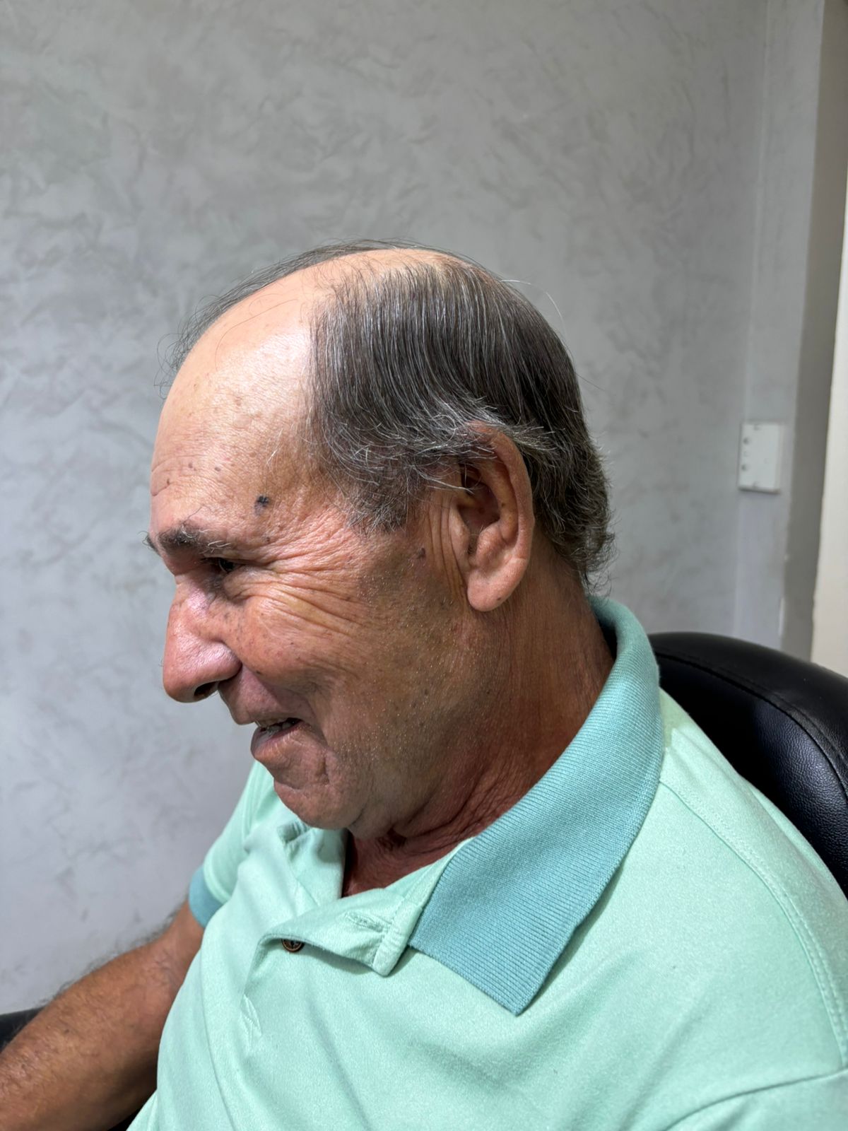 Antes da prótese capilar