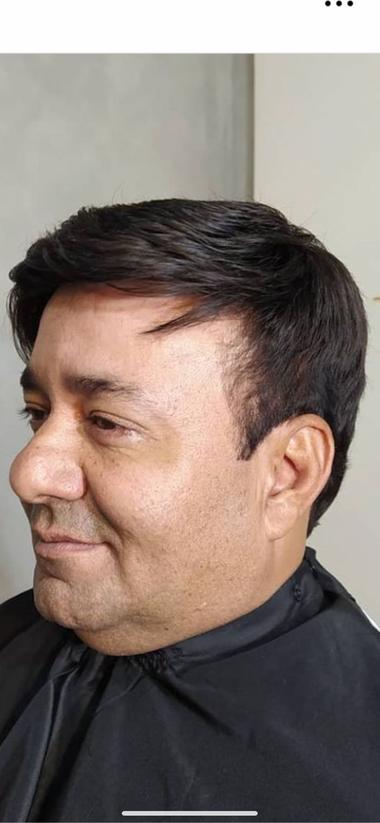 Depois da prótese capilar
